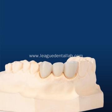 Customized Crown Porcelain Fused to Metal